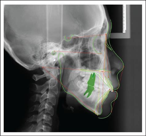 梁祐銘|Cephalometric Analysis